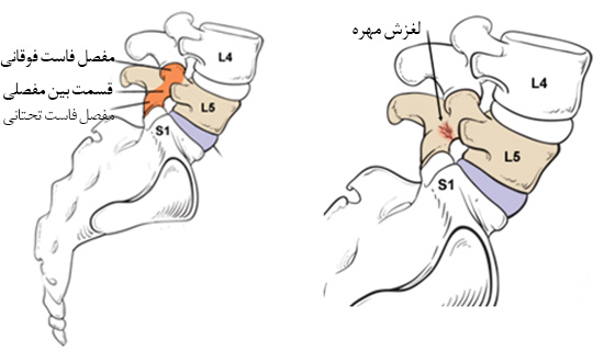 سوزش و ضعف رفتن ساق پا-6